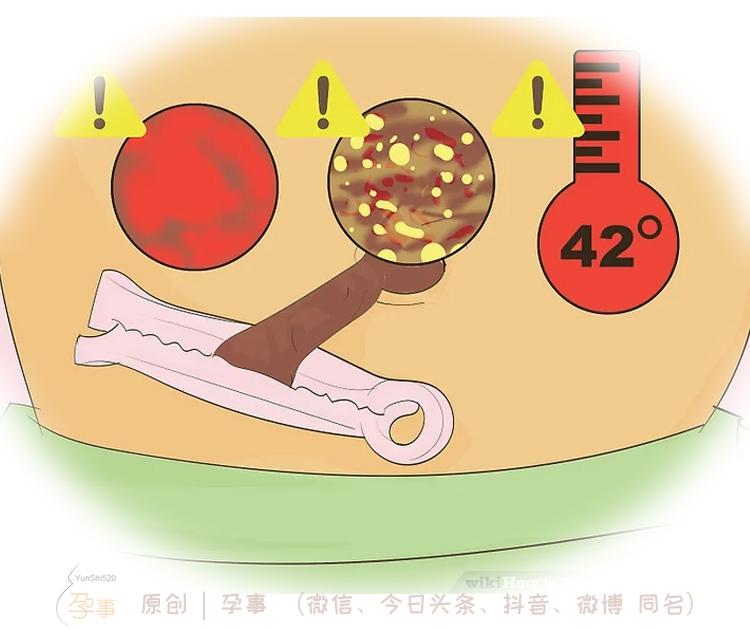 脐带发炎如何预防感染,新生儿脐带感染怎么处理