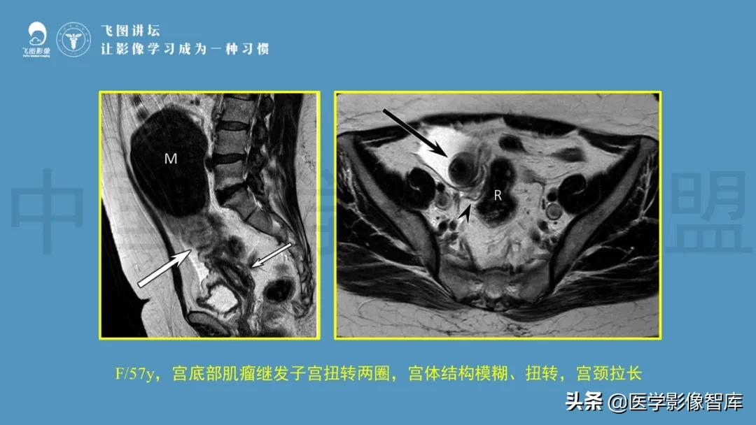 子宫解剖结构输卵管和卵巢位置,子宫附件ct影像学正常解剖表现