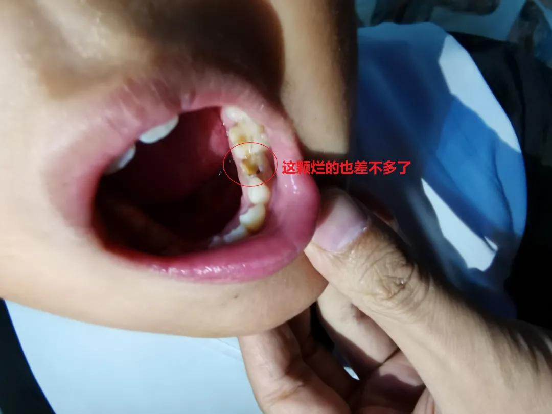 儿童看牙保险能报销吗,平安少儿齿科保险怎么样