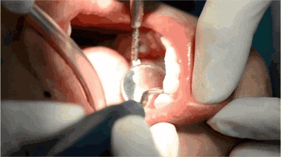 洗牙后牙齿酸软是怎么回事,洗牙后牙齿酸软怎么办