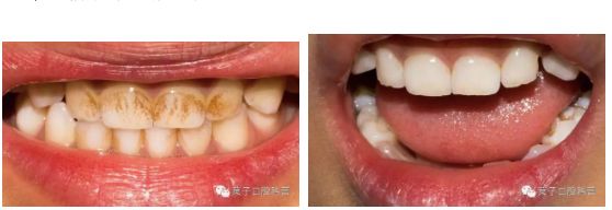 多图直击！牙医如何用抛光把孩子的牙洗干净？#葉子口腔科普#