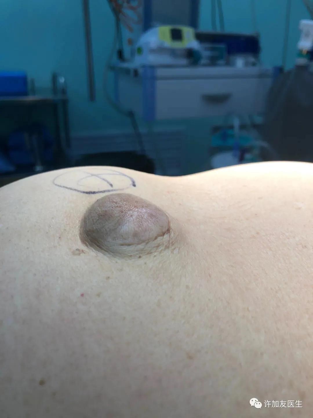 疝气婴儿肚脐眼图片,肚脐眼疝气能下去吗