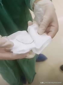 鏃犵棝鍒嗗ī瀵肩鏂,鎱у悍鏃犵棝鍒嗗ī鎵嬫湳