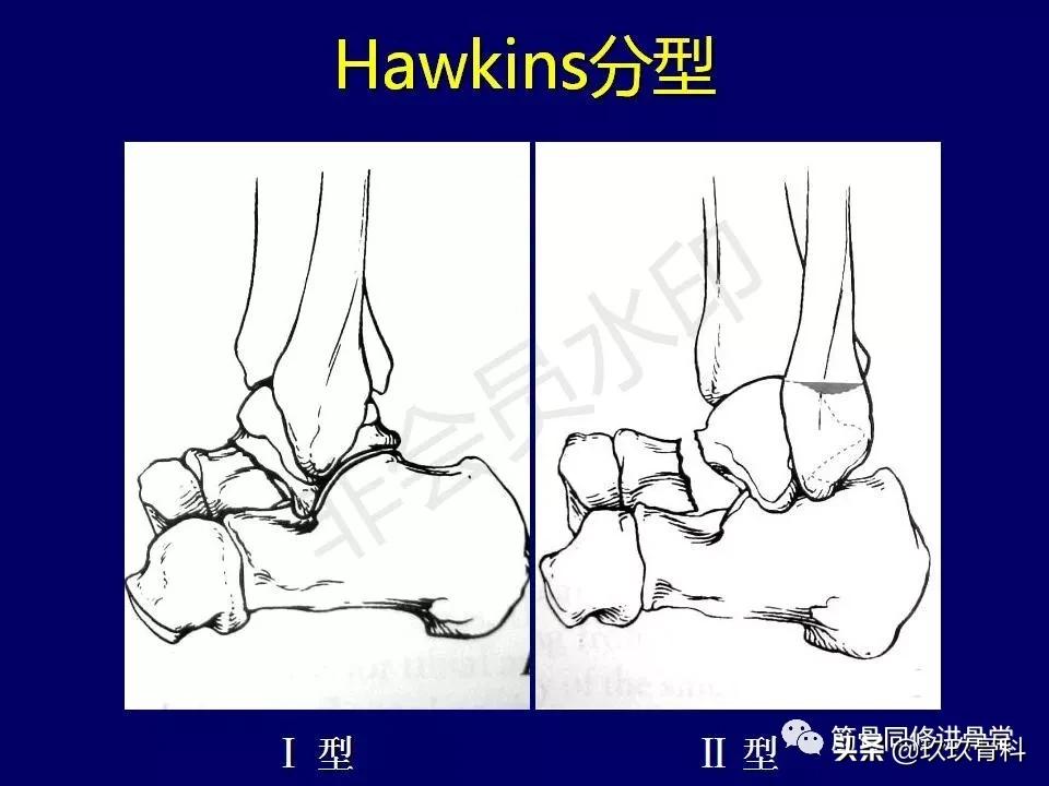 距骨骨折的治疗原则,距骨骨折如何调理