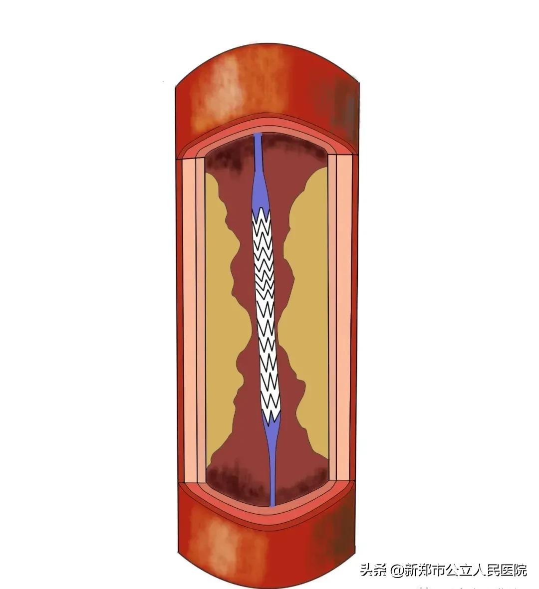 冠脉造影科普宣讲,冠脉CT血管造影