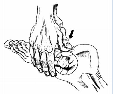 踝关节扭伤两个多月走路还跛脚,踝关节扭伤五个月了走路很痛还肿