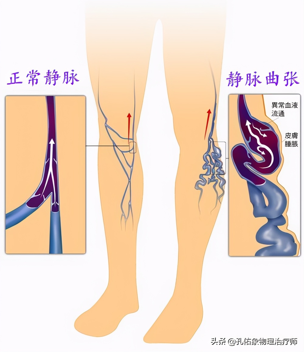 腿上细血管像蜘蛛样怎么回事,小腿上的血管像小蚯蚓一样