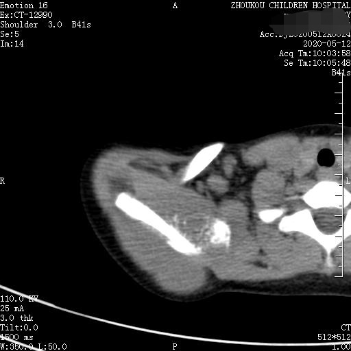 家长要警惕孩子腺样体面容,家长应该警惕孩子出现异常