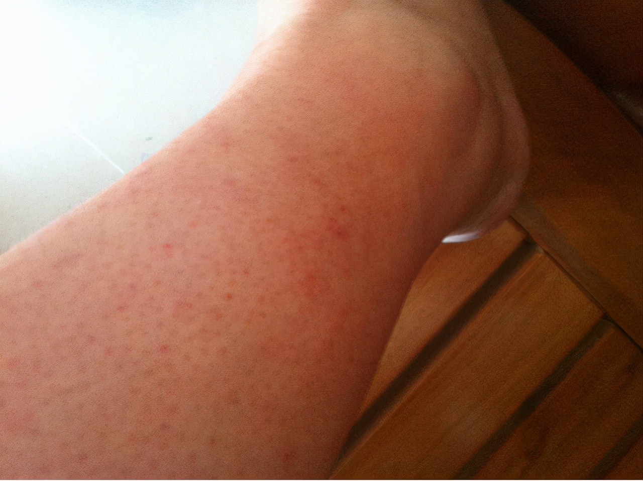 孕妈身上长红疙瘩很痒,准妈妈皮肤痒