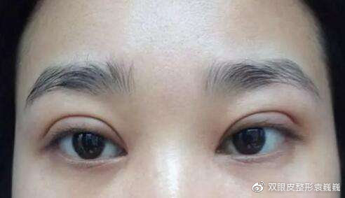 双眼皮一宽一窄修复视频,全切双眼皮修复宽改窄