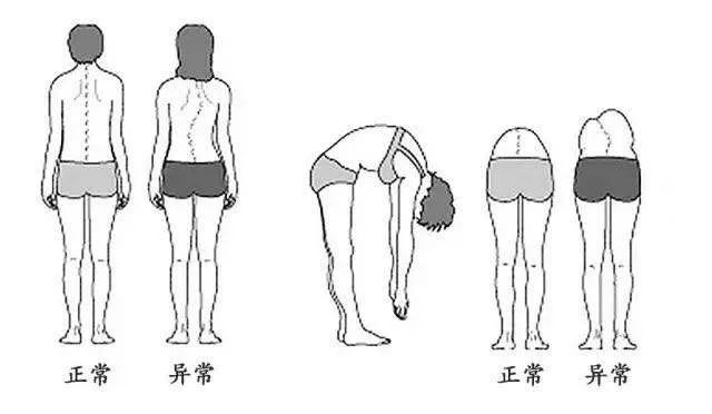 怎么拯救弯腰驼背的孩子,小孩脊柱不正怎么矫正最有效