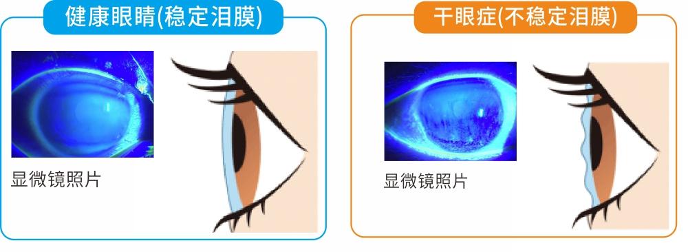 女孩眼睛长出“蜘蛛网”！医生：这病八成以上深圳人都有