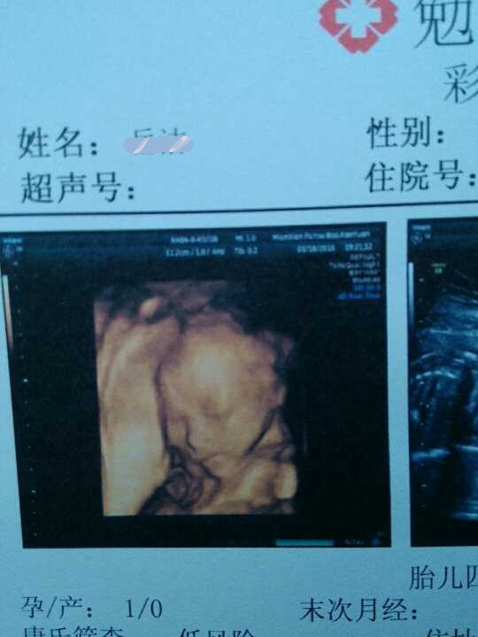 双角子宫怀孕能到足月出生吗,有双角子宫怀孕生子的吗