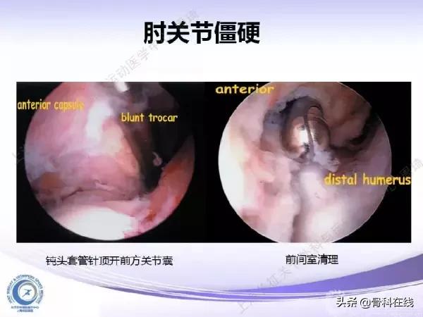 肘关节镜手术后引流,肘关节镜微创手术