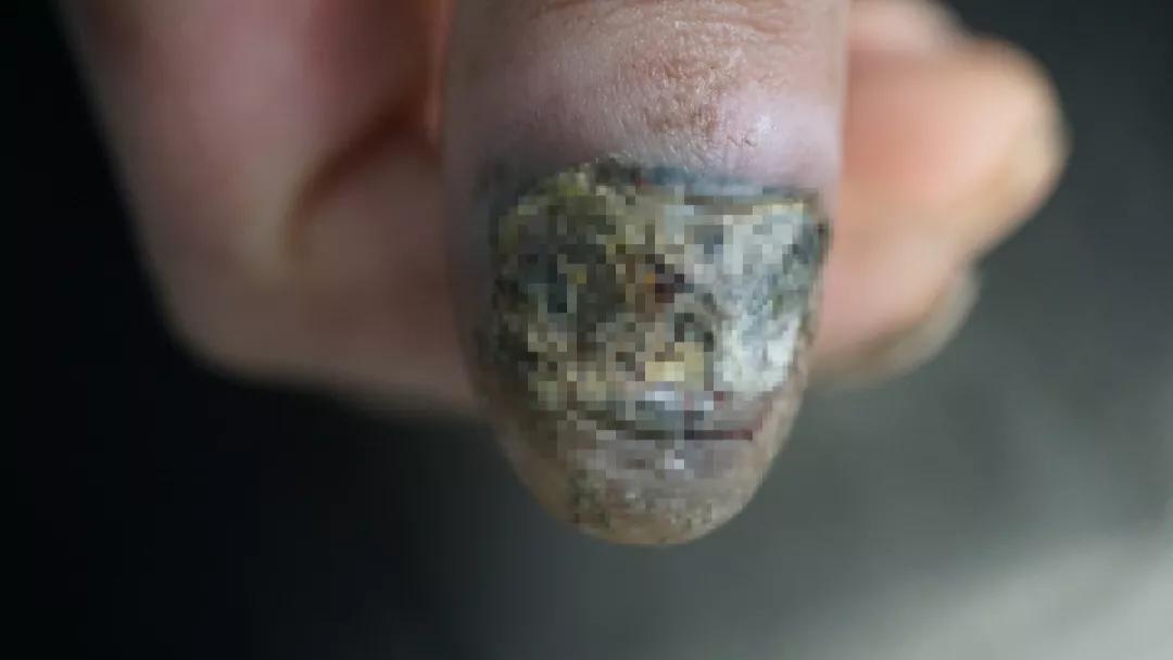 痣能点吗,我的痣凸起来会癌变吗