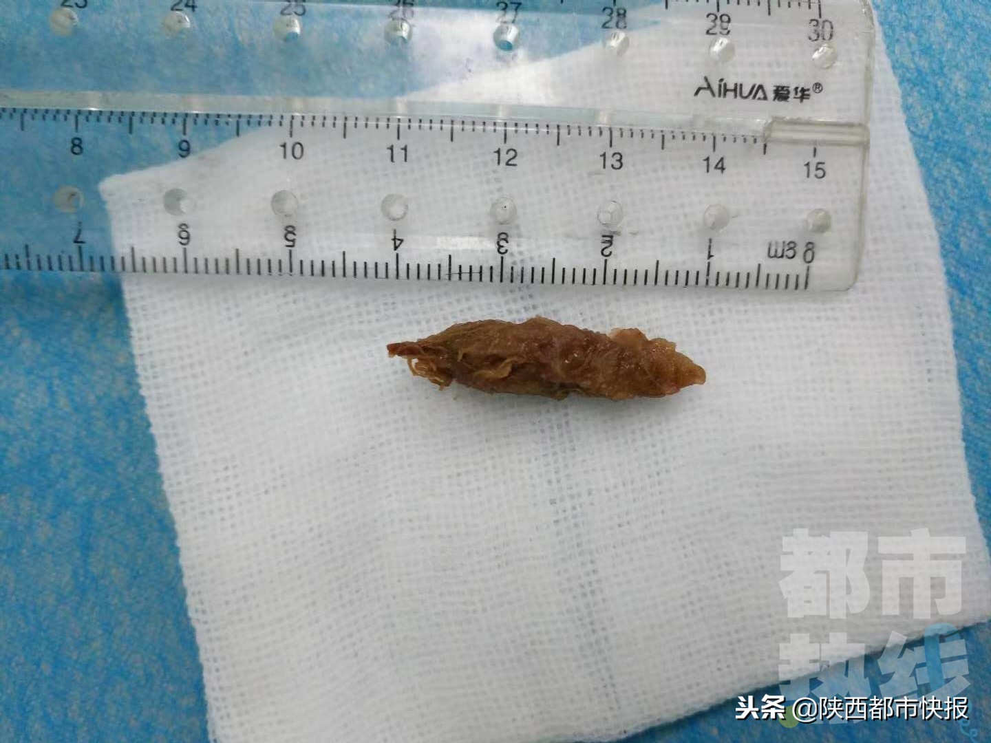 孕妇误食了枣核,孕妇不小心吞了一个红枣核要紧吗