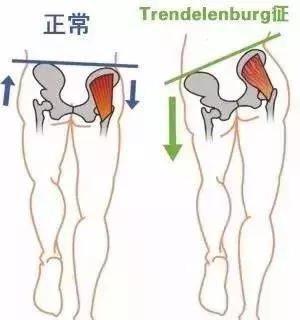 走路臀部晃,正确的走路臀部发力