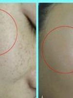 激光祛雀斑后每天变化图,激光祛雀斑反弹几率大吗