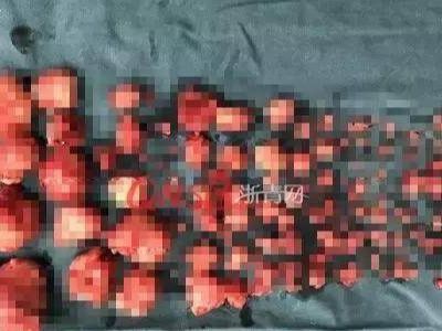 女性体内取出71个肌瘤,手术中挖出的子宫肌瘤