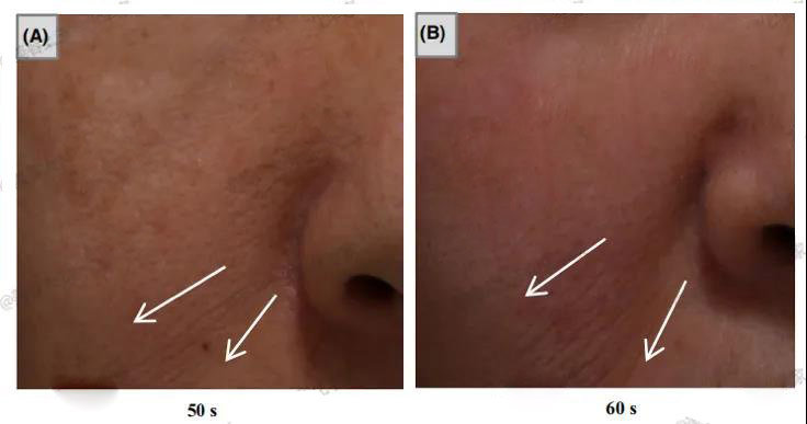 毛孔粗大抗炎,油脂性毛孔粗大怎么抗老