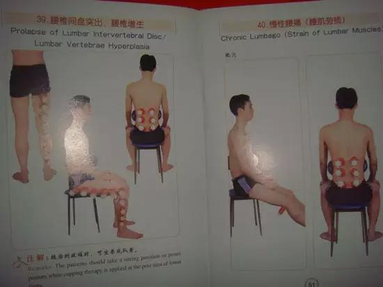 拔罐有哪些穴位图解,最全拔罐穴位疗法图解