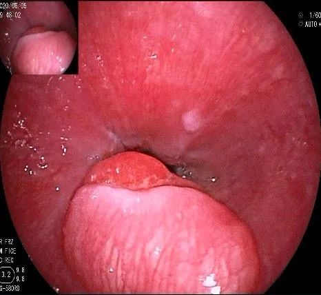 贲门处见隆起性病变,贲门高级别瘤变esd术后不能吃什么