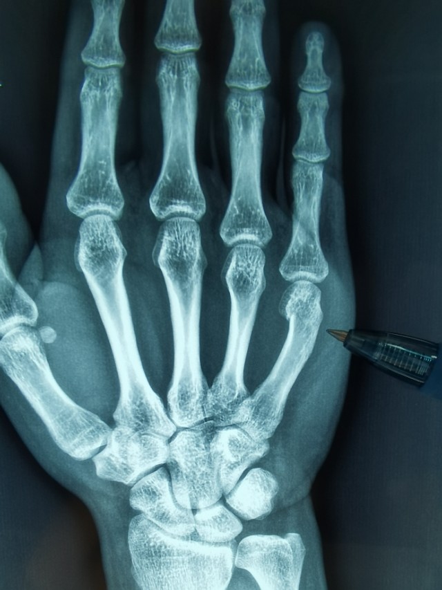 手部拳击骨折，不需要石膏固定，更不需要手术！！