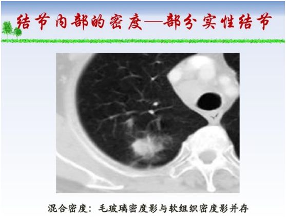 感冒以后做ct发现肺部小结节,乳腺癌术后复查ct发现肺部小结节