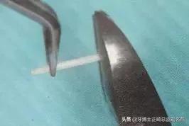 纤维桩修复费用,纤维桩修复全过程视频