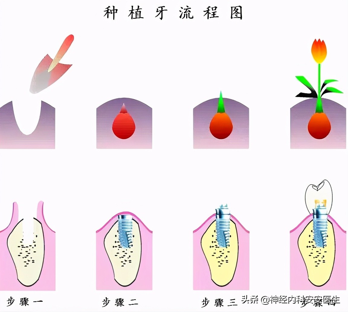 种植牙究竟是怎样的？是播种后再长出新牙齿吗？有哪些优缺点呢？