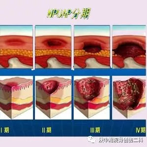 褥疮病人是不是要卧床休养,褥疮需要打消炎针吗