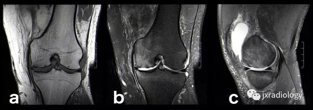 磁共振天天诊断骨髓水肿，但您知道原因吗？