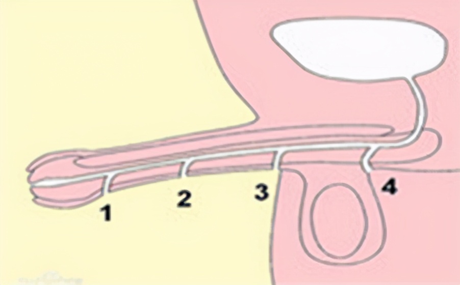 尿道下裂是啥样的,尿道下裂都有什么类型