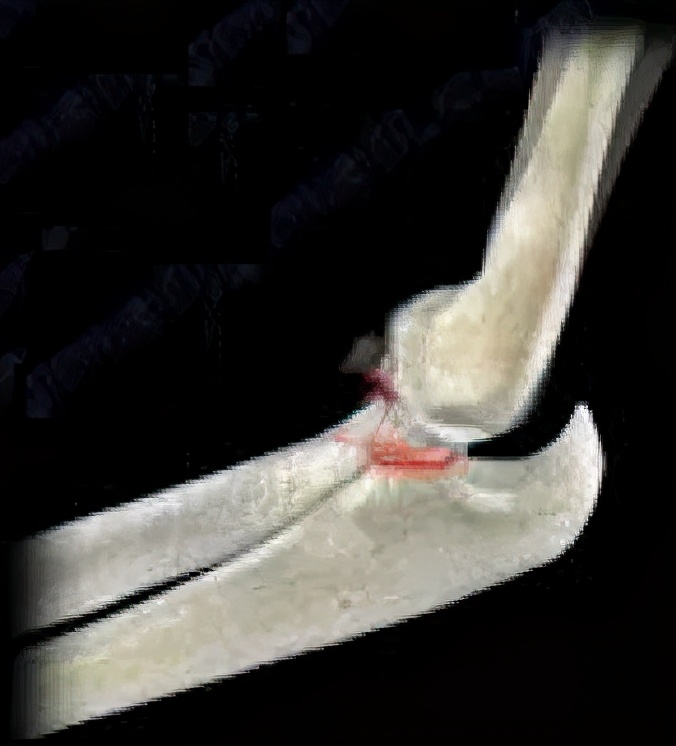 肘关节恐怖三联征康复训练图,肘关节恐怖三联征能彻底治愈吗