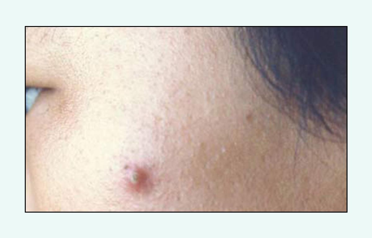 脸上的红疙瘩疼是什么原因,脸上的各种疙瘩