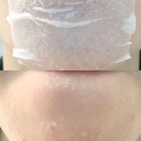 解决闭口最佳方法不复发,如何去闭口最有效方法