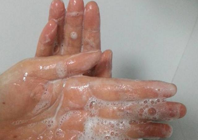 天气一热手上长水泡脱皮,为了避免手上起水泡该怎么预防