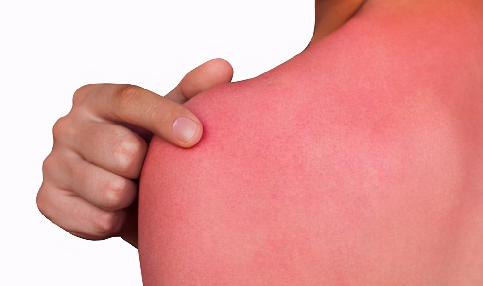 急性发热性嗜中性皮病病程多久,急性嗜中性发热性皮病不能吃什么