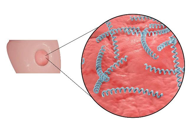 过敏性皮炎和梅毒疹有什么区别,不痒的皮疹都是梅毒疹吗