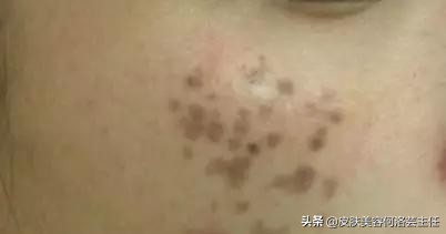 脸上有色斑应该怎么调理,脸上斑越来越多原因及治疗方法