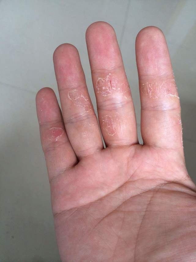 每到夏天长痱子怎么办,夏天身上起痱子怎么快速消失