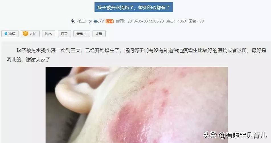 宝宝被烫伤第十三天,宝宝被开水烫伤要打针吗