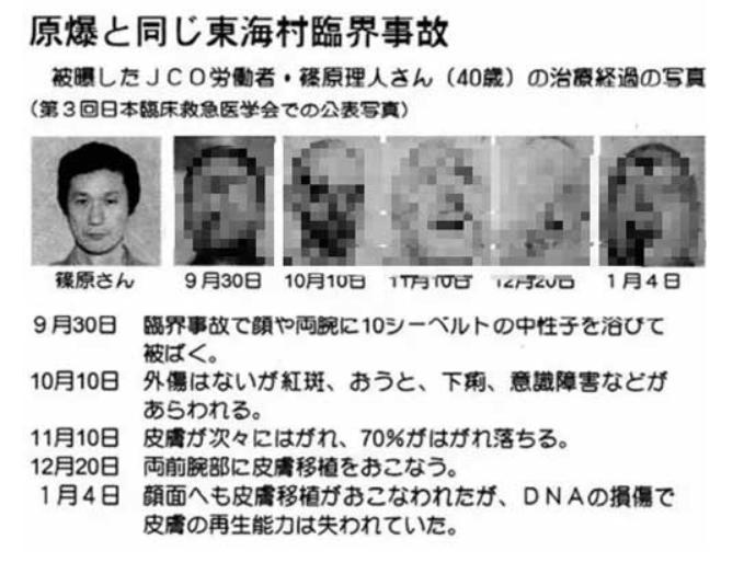 日本工人核辐射全身腐烂,日本工人核辐射事件