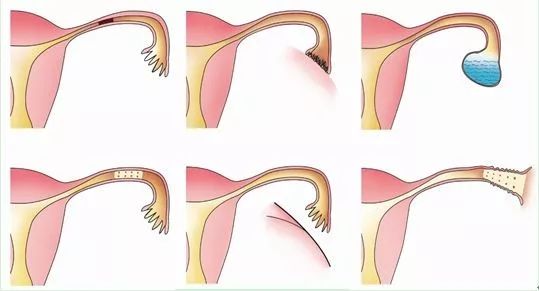 没做过人流，为何也成为输卵管堵塞的受害者？