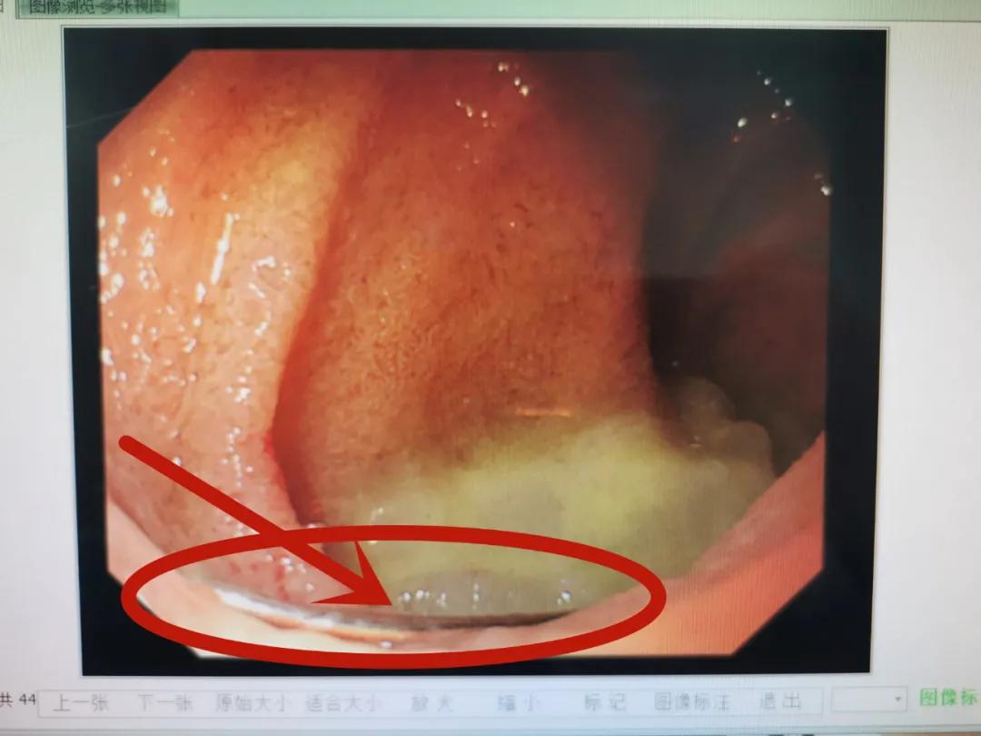 惊险！威海一宝宝吞下注射针头