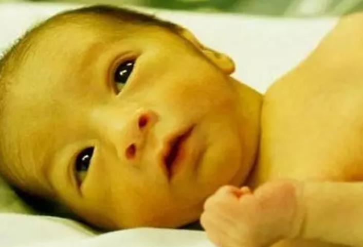 母乳性黄疸妈妈饮食禁忌,宝宝患母乳性黄疸怎么办