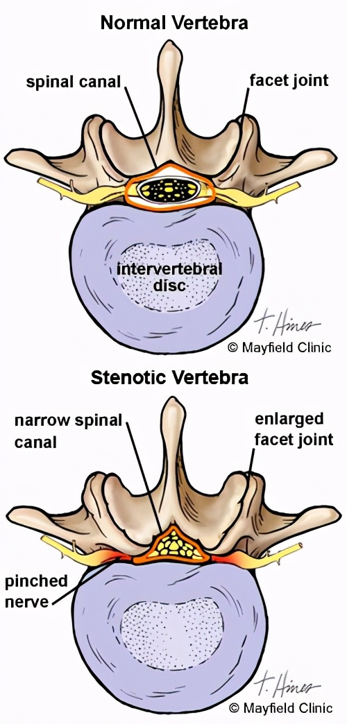 腰椎管狭窄一般能活多少年,腰椎管狭窄怎么锻炼最有效
