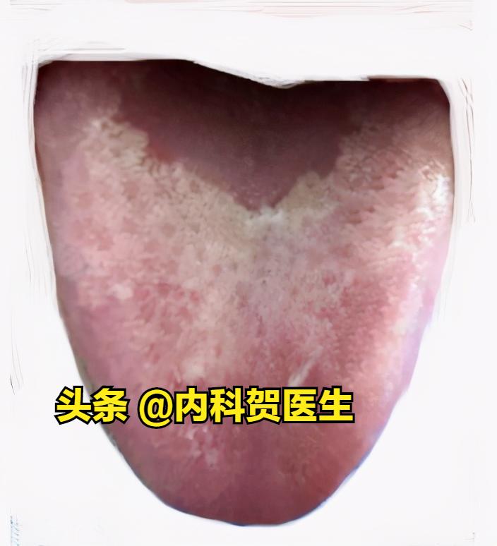 宝宝舌苔厚睡觉出汗爱趴着睡,小孩发烧舌苔厚腻睡觉出汗多