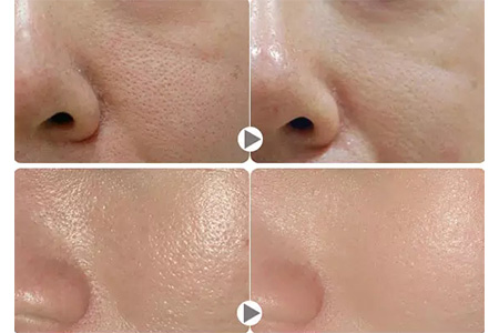 毛孔粗大的原因和护理方法,是什么原因导致毛孔粗大如何改善