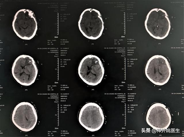 脑膜瘤是什么原因引起的啊,脑膜瘤手术治疗全部大概多少钱